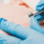 Cyst removal Cyst removal