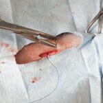 Stitching up a small laceration Stitching up a small laceration