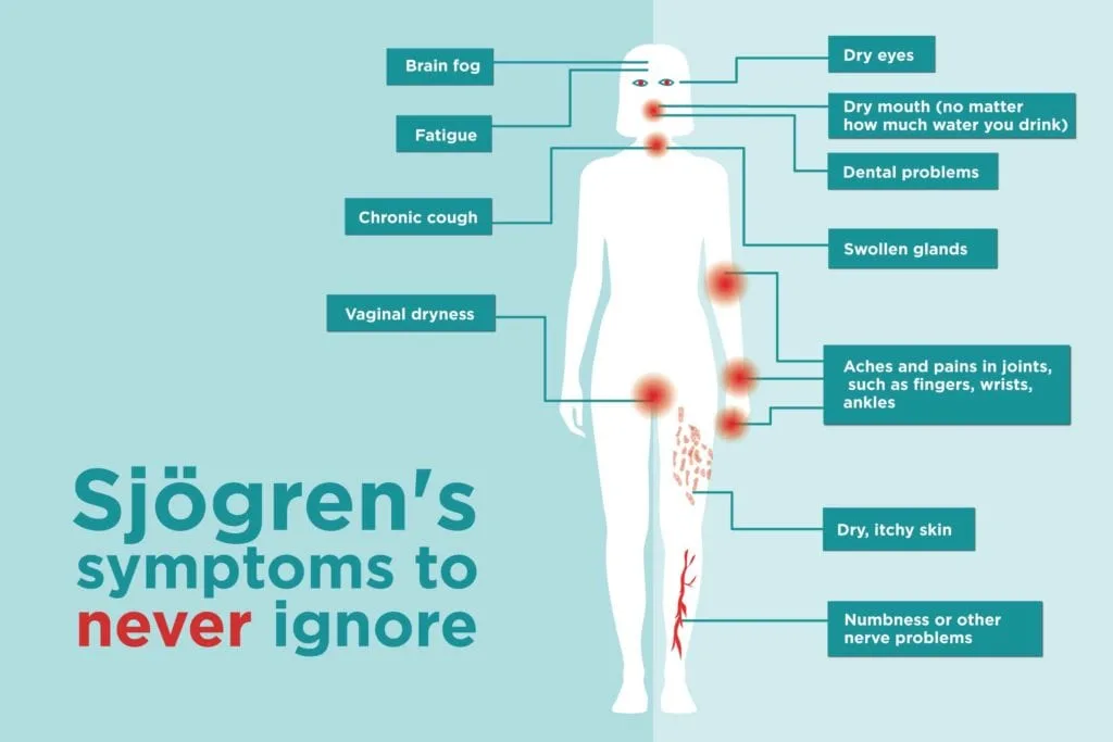 Sjögren’s Syndrome Symptoms: 11 Clues You Might Be Ignoring
